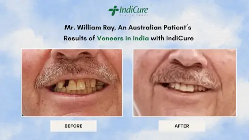 Results of Veneers in India